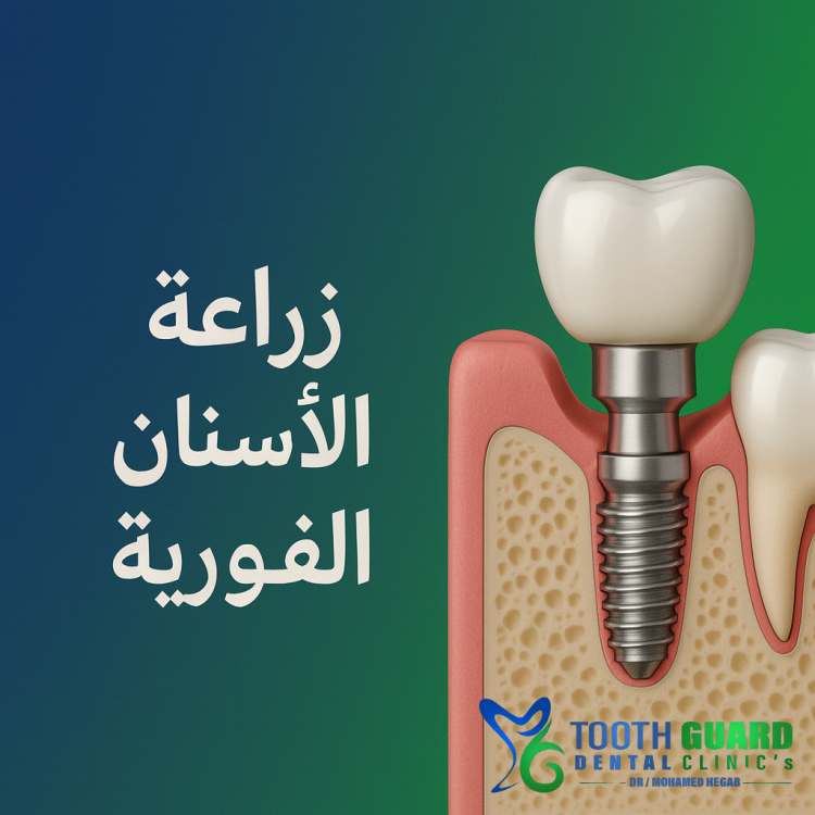 أسعار زراعة الاسنان الفورية في مصر